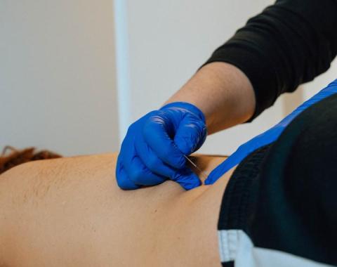 Punción seca: síndrome de dolor miofascial 