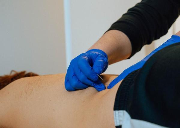 Punción seca: síndrome de dolor miofascial 